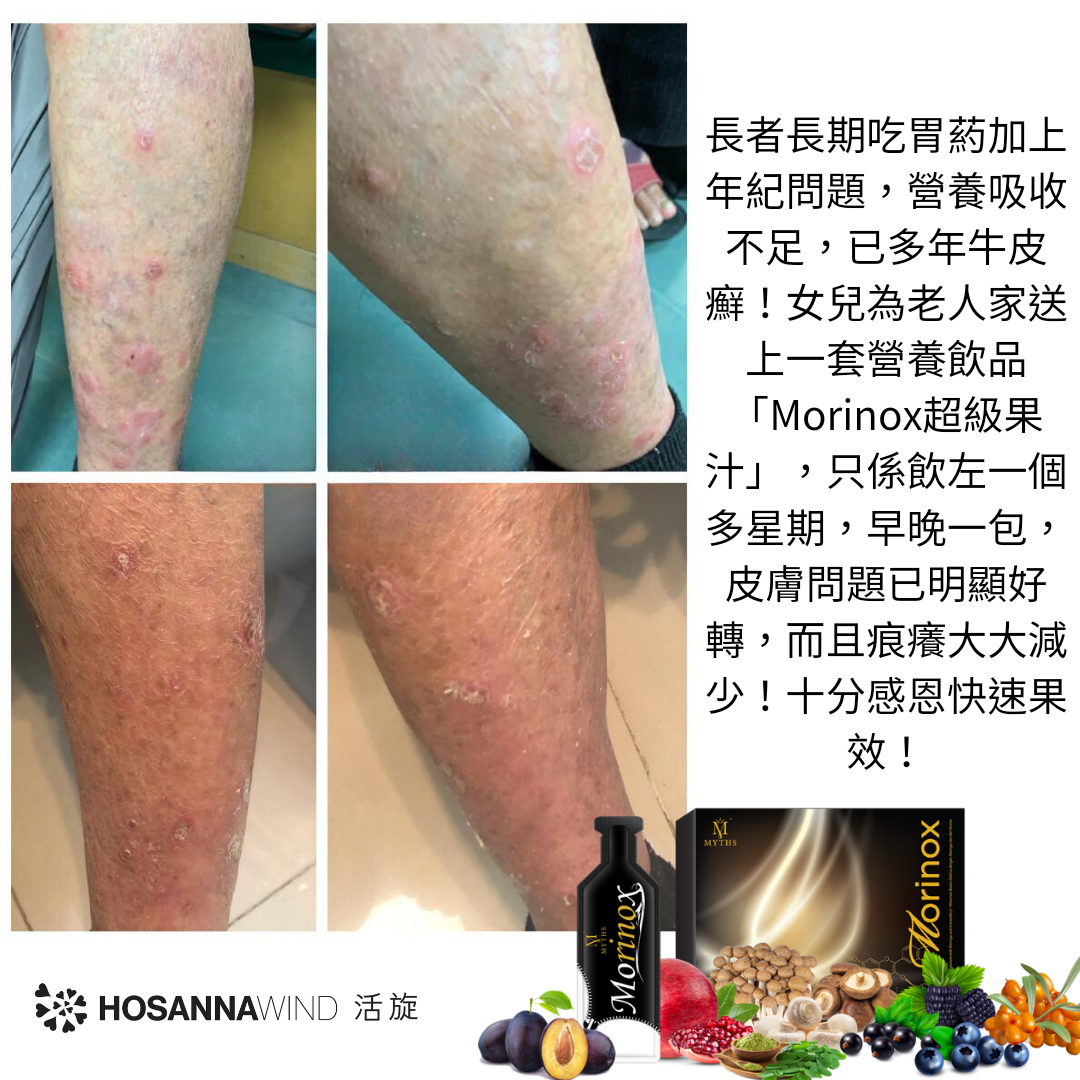 HOSANNAWIND MORINGA ECZEMA CARE TRIAL SET