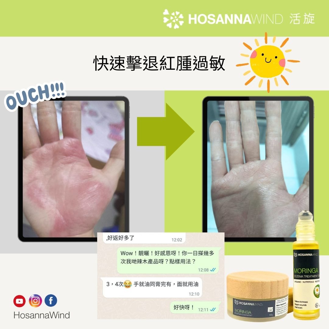 HOSANNAWIND ECZEMA TREATMENT OIL