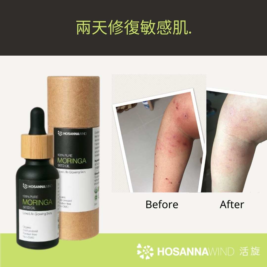 HOSANNAWIND MORINGA ECZEMA CARE TRIAL SET