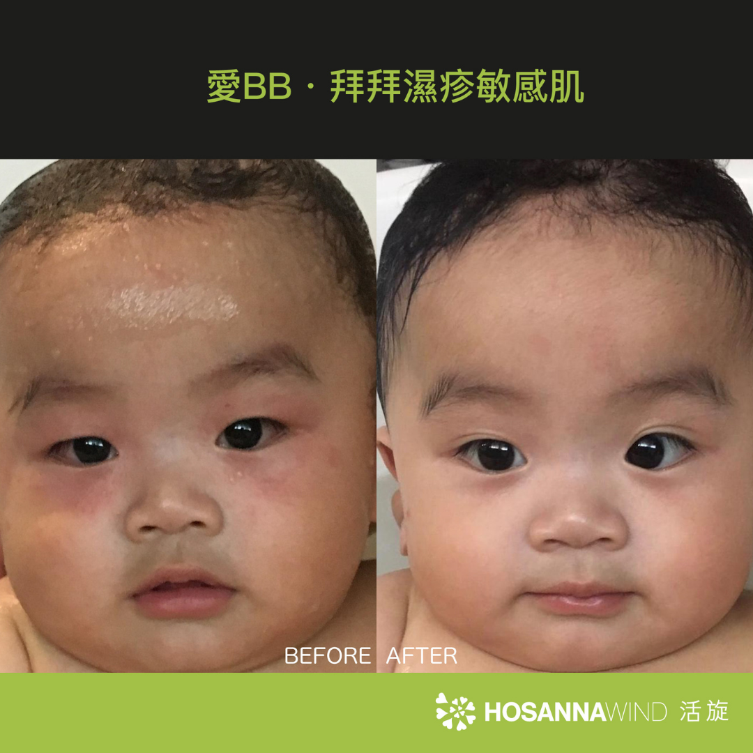 HOSANNAWIND MORINGA ECZEMA CREAM